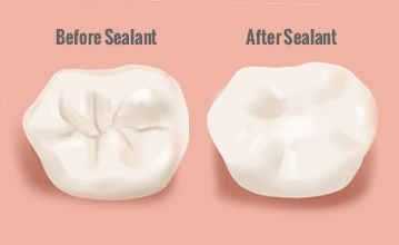Image result for Sealants