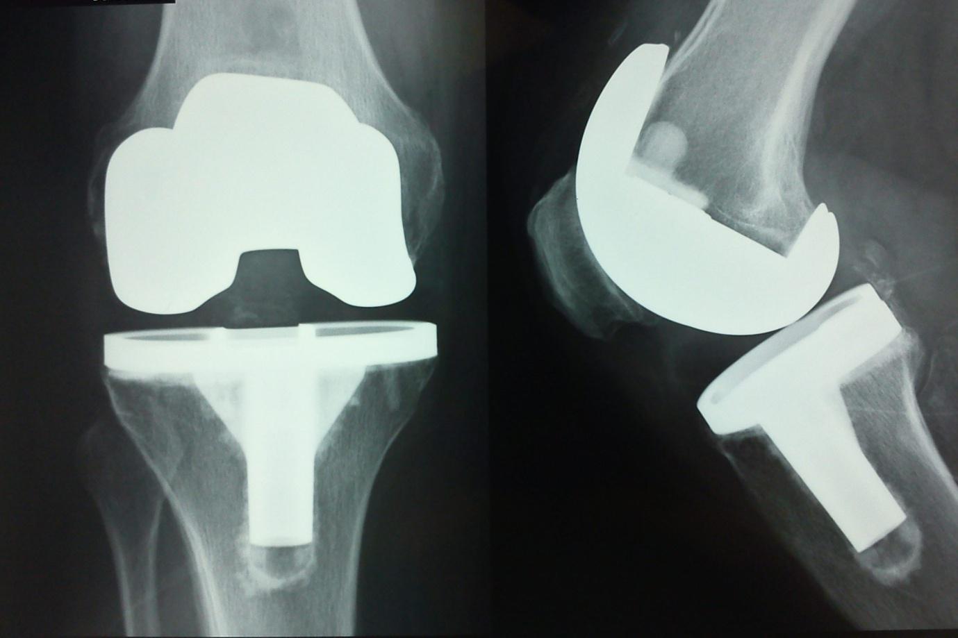 Total Knee Arthroplasty