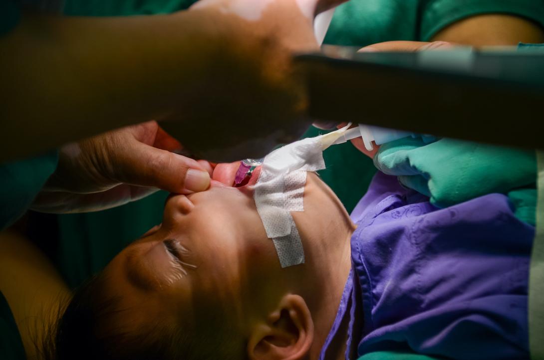 cleft palate surgery SHUTTERSTOCK