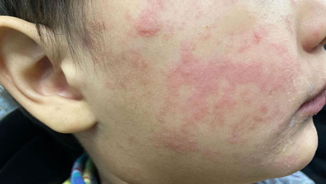 measles. CDC. WEB.