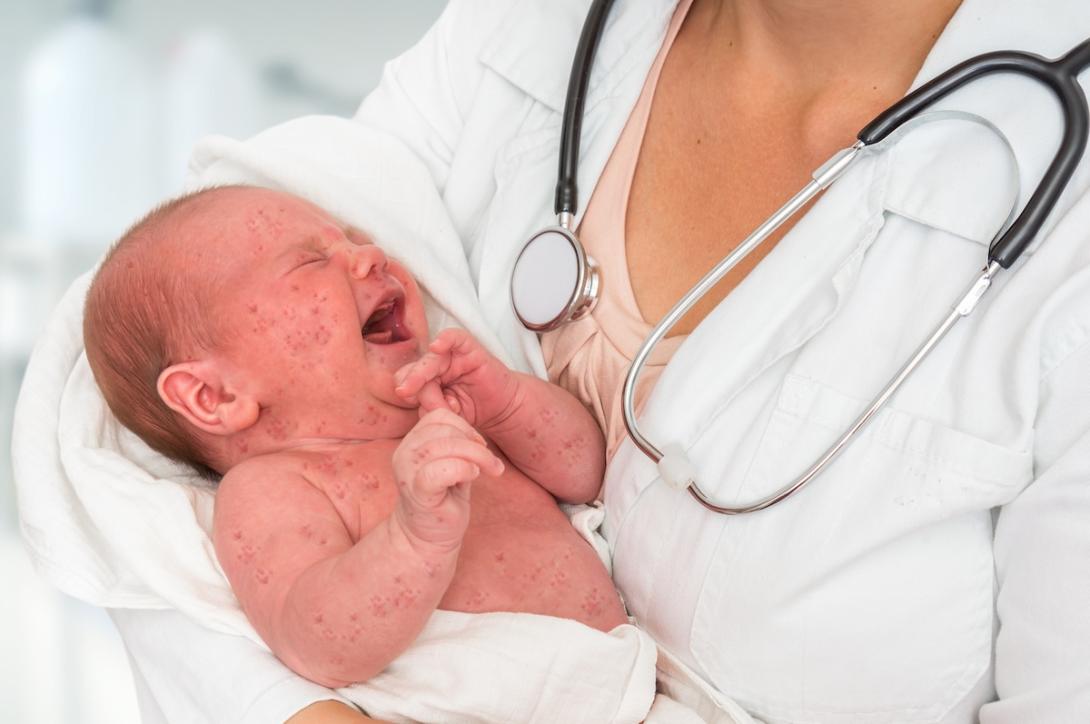 baby with measles in nurses arms