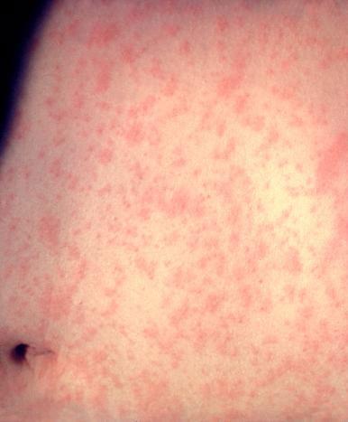 Measles rash after three days.