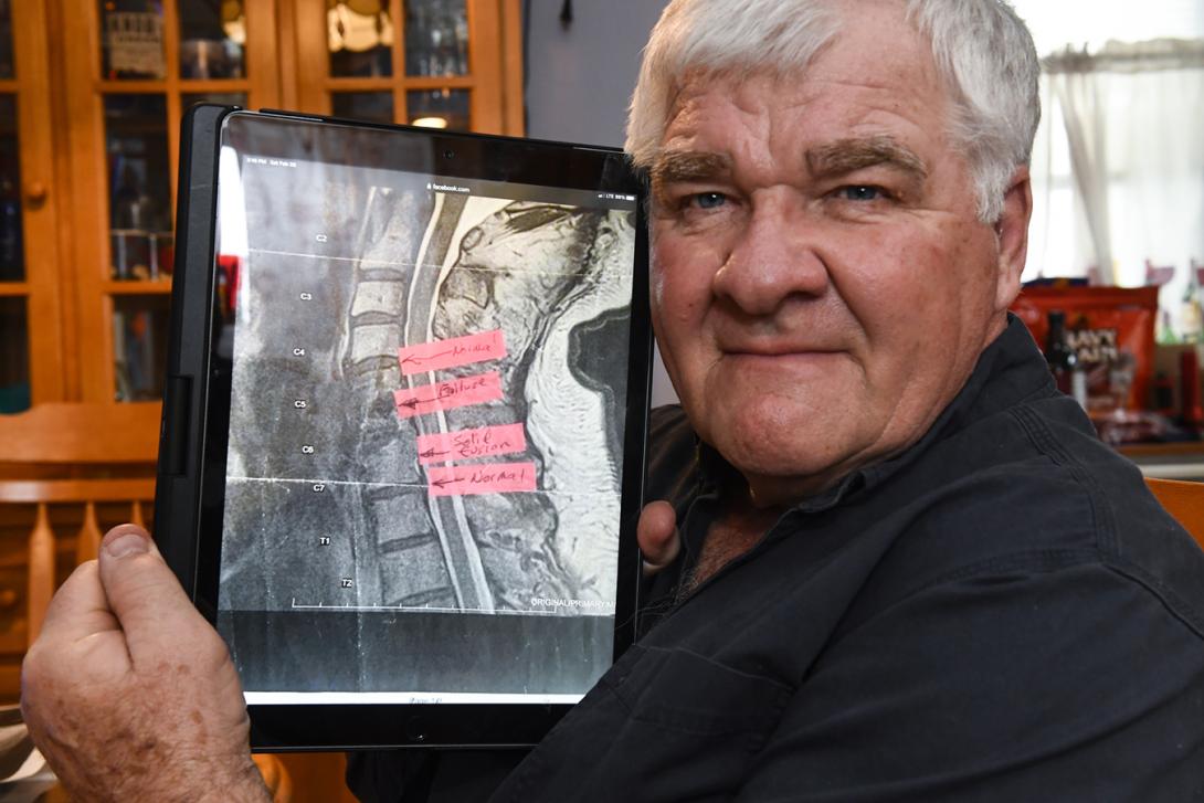 An older white man holding an image of his spinal erosion.